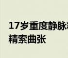 17岁重度静脉精索曲张严重吗 17岁重度静脉精索曲张 