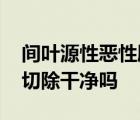 间叶源性恶性肿瘤能切除干净吗 恶性肿瘤能切除干净吗 